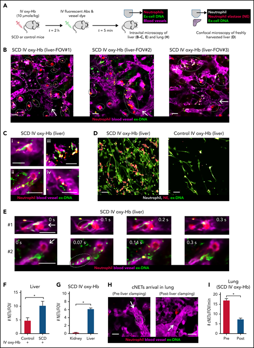 NETs are shed in the liver and then embolize to the lung as cNETs in SCD. (A) Experimental scheme: control mice or mice with SCD were IV administered 10 µmol/kg oxy-Hb or saline. Intravital fluorescence microscopy was used to assess the absence or presence of NETs within the liver (B,C,E) and lung (H) microcirculation. Microcirculation (pseudo-colored purple), neutrophils (pseudo-colored red), and extracellular DNA (pseudo-colored green) were labeled in vivo by IV administration of FITC or Texas-red dextran, Pacific blue–anti-Ly6G Ab and Sytox orange or green, respectively. Alternatively (D), freshly cut-unfixed slices of excised liver were stained in vitro for neutrophils (Pacific blue–anti-Ly6G Ab), extracellular DNA (Sytox green), and NE (AF546–anti-NE Ab), and confocal microscopy was used to identify NETs based on colocalization of DNA (green) with neutrophils (pseudo-colored white) and NE (red). Refer to supplemental methods for details. (B) Three representative liver intravital microscopy images (FOVs #1, #2, and #3) and the corresponding videos (supplemental Videos 11-13) reveal numerous NETs (marked with white dotted ellipses) and areas with impaired blood flow evident by slow transit of erythrocytes (dark cells) in the liver microcirculation of mice with SCD administered IV oxy-Hb. NETs were identified based on colocalization of neutrophil (red) and extracellular DNA (green). A vaso-occlusion evident by lack of vascular dye (purple) is marked with white dotted polygon in FOV#1. (C) Magnified intravital images of 4 different NETs in the liver microcirculation of mice with SCD administered IV Oxy-Hb. (D) Representative confocal micrographs reveal abundance of NETs (neutrophil-associated DNA strands positive for NE) in the liver of an SCD but rare in the liver of a control mouse administered IV Oxy-Hb. Neutrophils (pseudo-colored white), NE (red), and extracellular DNA (green). Colocalization of red and white appears pink. Individual channels shown in supplemental Figure 9. (E) Two separate time series of liver intravital images (#1, top row, and #2, bottom row) showing shedding of NETs in the liver microcirculation of mice with SCD administered IV oxy-Hb. (#1) A fragment of ex-DNA (green; marked with dotted ellipse) starts to detach from the neutrophil (red) at t = 0.1 seconds and disappears into the microcirculation (purple) by t = 0.3 seconds. (#2) Several fragments of ex-DNA (green; marked with dotted ellipse) detach from the neutrophil (red) at t = 0.07 seconds and disappear into the microcirculation (purple) by t = 0.3 seconds. Time points are relative to the first frame shown at t = 0 seconds. Complete times series #1 and #2 shown in supplemental Videos 14 and , respectively. (F) Confocal micrographs (representative example shown in panel D) were quantified to reveal significantly more #NETs/FOV in the liver of SCD than control mice administered IV oxy-Hb. n = 6 FOVs in each group. FOV size ∼144 400 µm2. (G) Liver and kidney intravital microscopy images were quantified to estimate number of NETs per FOV (#NETs/FOV). #NETs/FOV was significantly higher in the liver than kidney of mice with SCD administered IV Oxy-Hb. SCD IV Oxy-Hb kidney (n = 3 mice; 35 FOVs), SCD IV Oxy-Hb liver (n = 4 mice; 44 FOVs). (H-I) Intravital lung microcopy was used to assess the effect of simultaneously ligating the hepatic artery and portal vein (liver clamping), on the arrival of cNETs in the lung microcirculation of mice with SCD administered IV oxy-Hb. In qFILM FOVs from same mouse (panel H and supplemental Video 18), cNETs (green; marked with dotted white circle) are seen entering the pulmonary arteriole pre- but not postclamping of liver blood flow. More FOVs are shown in supplemental Figure 13; supplemental Videos 25 and . (I) Number of cNETs arriving in the lung per FOV over a 1-minute duration (#cNETs/FOV/min) were significantly reduced (threefold) following clamping of liver blood flow in mice with SCD administered IV oxy-Hb (n = 5 mice; 45 FOVs preclamp; 33 FOVs postclamp). Intravital microscopy FOV size ∼65 536 µm2. Scale bars, 20 µm. Data in panels F, G, and I represent mean ± SE and were compared using Student t test. *P < .05. Arrow denotes the direction of blood flow.