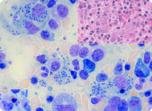 A 25-year-old previously healthy man presented to an outside clinic because he had experienced 6 weeks of left upper quadrant abdominal pain and new onset of fevers, headache, and watery diarrhea. He was admitted to an outside hospital and was found to have splenomegaly with splenic infarcts and pancytopenia (white blood cell count, 1.6 × 109/L; hemoglobin, 5.8 g/dL; platelet count, 60 × 109/L). A bone marrow biopsy reported findings of suspected myelodysplastic syndrome. Upon referral to our hospital, a repeat bone marrow biopsy identified numerous kinetoplast-containing organisms in the aspirate (central portion of figure: 100× lens objective, total magnification ×120; Wright-Giemsa stain) and biopsy (upper inset: intrahistiocytic organisms; 40× lens objective, total magnification ×400; hematoxylin and eosin stain), with only rare morphologic evidence of dysplasia with <10% nuclear dyserythropoiesis as shown in the lower inset (100× lens objective, total magnification ×120; Wright-Giemsa stain) and 46,XY karyotype. Fungal and gram stains were negative. DNA extracted from the aspirate and sequenced in-house was positive for Leishmania donovani complex. The patient’s history revealed that he had lived in the Oaxaca Mountains in Mexico for the past 3 years. He was promptly diagnosed with visceral leishmaniasis (VL) and was treated with liposomal amphotericin B with good response.