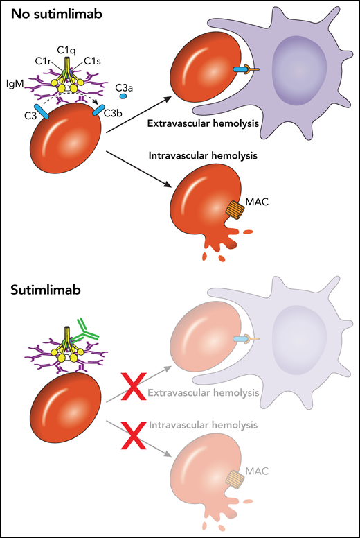 Sutimlimab reduces intravascular and extravascular hemolysis in CAD by inhibiting C1s. CAD results from monoclonal IgM antibodies that target carbohydrate antigens on the surface of red blood cells, leading to complement fixation. Early IgM-induced complement activation can lead to extravascular hemolysis by facilitating macrophage engagement or can lead to intravascular hemolysis by proceeding to terminal complement activation and membrane attack complex (MAC) formation. Sutimlimab inhibits early complement activation by targeting C1s, thereby protecting cells from complement-mediated extravascular and intravascular hemolysis. Professional illustration by Patrick Lane, ScEYEnce Studios.