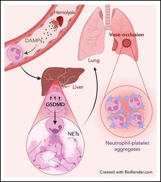 Liver-to-lung NET embolization in SCD. Hemolysis releases DAMPs that prime neutrophils and lead to the activation of an interferon and gasdermin-D (GSDMD)-dependent signaling pathway, which promotes NET generation into the liver microcirculation. These NETs carried through the blood into the lungs can then promote neutrophil-platelet aggregation, leading to pulmonary vasoocclusion.