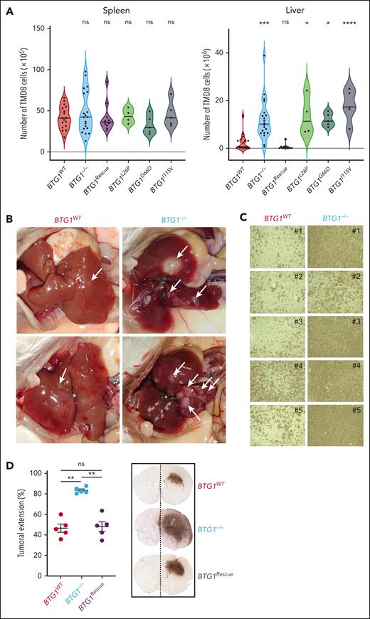 BTG1 inactivation and mutations promote lymphoma dissemination. (A) Flow cytometry quantification of TMD8 cells (GFP+, human CD19+) in the spleen (left) and liver (right) of recipient NSG mice 5 weeks after intrasplenic xenograft (TMD8-BTG1WT, n = 17 BTG1−/−, n = 20; BTG1rescue, n = 9; Rescue L26P, n = 4, Rescue G66D, n = 5, Rescue I1115V, n = 5). (B) Macroscopic examination and (C) immunohistochemical human CD20 staining of the liver of TMD8-BTG1WT and TMD8-BTG1−/−recipients. (D) Quantification of tumoral extension by human CD20 immunohistochemical staining of NSG mice brains after stereotaxic injection of TMD8-BTG1−/−, TMD8-BTG1WT, or TMD8-BTG1rescue cells in the right hemisphere (n = 5) and representative images of human CD20 staining. Values represent mean or mean ± SEM; ∗P < .05; ∗∗P < .01; ∗∗∗P < .001; ∗∗∗∗P < .0001; using one-way ANOVA with Tukey multiple comparisons test in panel A or Mann-Whitney test in panel D. ANOVA, analysis of variance; ns, not significant; SEM, standard error of the mean.