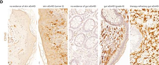 CD163+cells are abundant in PBMC, skin, and GI tract samples of patients with acute GVHD. (A) Hierarchical stochastic neighbor embedding (HSNE)–guided dissection of blood-derived myeloid cells that belong either to the monocyte or DC lineage. (B) Heatmap showing 11 different monocyte subclusters (CD14+CD16– classical, CD14+CD16dim/intermediate, or CD14neg/dimCD16bright nonclassical monocytes) and 11 DC subclusters (CD11b–CD11c+CD123dim conventional cDCs and CD11b–CD11c–CD123+ plasmacytoid pDCs). Cluster annotation numbers displayed in (A) correspond to the numbers shown in (B). (C) Boxplots showing the relative abundance (median and interquartile range) of distinct monocyte subclusters, analyzed at 2 or 3 consecutive time points as indicated on the x-axis, that are significantly more (top row) or less (middle row) prevalent in HSCT patients who developed aGVHD. DC subclusters most prevalent in therapy refractory aGVHD patients (nonresponsive to MSC-based second-line therapy) are indicated in the bottom row. Healthy ctr, healthy control participants; HSCT ctr, patients who underwent HSCT without aGVHD; Steroid-CR, patients who underwent HSCT and demonstrated aGVHD responsive to steroids; GVHD-CR, HSCT patients with steroid-refractory aGVHD responsive to MSC-based second-line therapy; GVHD-NR, HSCT patients with steroid-refractory aGVHD nonresponsive to MSC-based second-line therapy. (D) Representative images of the abundant presence of CD163+ cells (stained in brown) in skin and colon biopsy samples from patients with aGVHD. Note the sporadic presence of CD163+ cells in colon and skin biopsy samples collected from patients suspected of skin or gut aGVHD after undergoing HSCT. These biopsy samples however displayed no convincing pathologic features of aGVHD. The biopsy sample obtained after MSC therapy initiation (right panel) is derived from one of the patients with refractory aGVHD who did not respond to steroids and MSC. ∗P < .05; ∗∗P < .01; ∗∗∗P < .001.