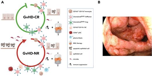 Different patterns of immune cell activation and tissue destruction in patients with steroid-refractory aGVHD responding differently to MSC therapy. (A) Graphical depiction of the appearance of characteristic immune populations and degree of epithelial cell damage in patients with aGVHD either responding (top) or refractory (bottom) to second-line immunosuppressive therapy. Both patient groups were treated consecutively with first-line immunosuppressive and second-line MSC therapy. HSCT patients with steroid-refractory aGVHD either responsive or nonresponsive to MSC-based second-line therapy groups (GVHD-CR and GVHD-NR, respectively) initially showed high frequencies of circulating CD163+CD11b+ monocytes and CXCR3+CCR9+CCR10+ effector T cells shortly after introduction of immunosuppressive therapy. Patients nonresponsive to MSC-based second-line therapy further showed increased frequencies of CD163+CD11b– DCs, CD56+ DCs, and plasmablasts, which persisted over time. In patients responsive to MSC-based second-line therapy, who showed complete resolution of all clinical aGVHD symptoms, CXCR3+CCR9+CCR10+ effector T cells, along with CXCR3+CCR9+CCR10+ Tregs, decreased over time. These populations remained high in the group of patients nonresponsive to MSC-based second-line therapy, indicative of escalating immune reactivity leading to progressive tissue damage in aGVHD target organs, loss of epithelial barrier function, and concurrent infectious complications. (B) Endoscopy image showing the macroscopic appearance of the colon of one of the patients nonresponsive to MSC-based second-line therapy. The biopsy was taken after MSC therapy was initiated.