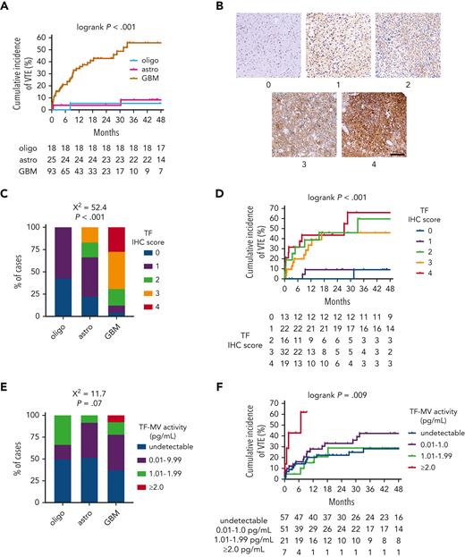 TF expression and circulating TF-MV activity in NMH newly diagnosed adult-type diffuse glioma cases. (A) Cumulative VTE incidence according to glioma genotype. (B) Representative photomicrographs of TF IHC, on a semiquantitative scale from 0 (negative) to 4 (strongest). Scale bar = 50 μm. (C) TF IHC scores across the 3 subsets of adult-type diffuse gliomas. (D) Cumulative VTE incidence according to glioma TF IHC score. (E) Circulating TF-MV activity, at the time of initial surgery, across the 3 subsets of patients with adult-type diffuse glioma. (F) Cumulative VTE incidence according to circulating TF-MV activity at the time of initial surgery. Astro, IDHmut grade 2 to 4 astrocytoma; GBM, IDHwt glioblastoma; oligo, IDHmut, 1p/19q-codeleted WHO grade 2 to 3 oligodendroglioma.