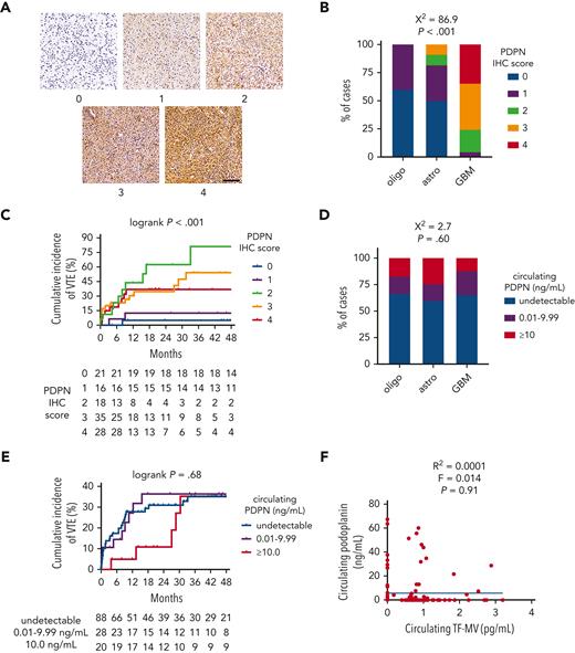 PDPN expression and circulating PDPN in NMH newly diagnosed adult-type diffuse glioma cases. (A) Representative photomicrographs of PDPN IHC, on a semiquantitative scale from 0 (negative) to 4 (strongest). Scale bar = 50 μm. (B) PDPN IHC scores across the 3 subsets of adult-type diffuse gliomas. (C) Cumulative VTE incidence according to glioma PDPN IHC score. (D) Circulating PDPN, at the time of initial surgery, across the 3 subsets of patients with adult-type diffuse glioma. (E) Cumulative VTE incidence according to circulating PDPN at the time of initial surgery. (F) Linear regression plot of circulating TF-MV activity vs circulating PDPN at the time of initial surgery. Astro, IDHmut grade 2 to 4 astrocytoma; GBM, IDHwt glioblastoma; oligo, IDHmut, 1p/19q-codeleted WHO grade 2 to 3 oligodendroglioma.