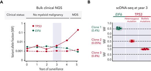 Clonal dynamics of somatic mutations in SDS. (A) Representative example of clinical NGS in a patient with SDS undergoing serial bone marrow examinations. TP53- and EIF6-mutated clones are colored red and green, respectively. Solid red line corresponds to the biallelic TP53 clone that eventually progresses to MDS. Light-blue bar highlights year 3 of bone marrow surveillance. (B) scDNA-seq at year 3 of surveillance. Each row represents a unique EIF6- and TP53-mutated clones with VAF as a percentage below. Each dot corresponds to a single cell belonging to a given clone. Heterozygous mutations have a VAF of ∼0.5. The TP53 mutation in clone 3 has a VAF of ∼1.0, indicating biallelic TP53 mutation. The biallelic TP53-mutated clone expands exponentially and represents the dominant clone at the time of MDS diagnosis. This scenario demonstrates the ability of scDNA-seq to reveal the clonal hierarchy of somatic mutations and identify high-risk TP53 mutations years before the clinical diagnosis of a myeloid malignancy. In addition, we provide a specific clinical example in the text describing a patient with SDS who was found to have a detectable biallelic TP53-mutated clone using scDNA-seq that eventually gave rise to leukemia despite no other concerning clinicopathologic or cytogenetic features during routine surveillance of bone marrow and blood counts a few months preceeding leukemia diagnosis.