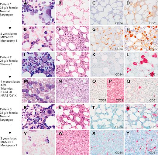 Myeloid progression in GATA2 deficiency. (A-D) A 35-year-old (35 y/o) female with neutropenia, normal hemoglobin and platelet count, and very low monocytes, B cells, and NK cells count. (A) BM aspirate showed dysplastic MKs with minimal morphologic dysplasia in other lineages and no increase in blasts. (B) The biopsy was hypocellular with trilineage hematopoiesis, (C) low number of CD34+ cells, (D) few atypical MKs highlighted by CD61, and normal cytogenetics. (E-F) Six years later, she presented with severe anemia with 16% circulating blasts. (E)The marrow aspirate showed increased scattered blasts. (F) The marrow biopsy was hypercellular with (G) 10% CD34+ blasts, (H) increased CD61+ dysplastic MKs and increased reticulin fibrosis (not shown) indicative of MDS with excess blasts. Cytogenetics showed presence of monosomy 6. A germ line GATA2 mutation was subsequently identified (T354M). (I-L) A 24-year-old female with a prior diagnosis of aplastic anemia in adolescence presented with moderate pancytopenia and very low monocytes, B cells, and NK cells count. (I) The marrow aspirate and (J) BM biopsy showed normocellular marrow with trilineage hematopoiesis, (K) no increase in CD34 positive blasts, and (L) moderate dysmegakaryopoiesis. Cytogenetics revealed trisomy 8. Germ line GATA2 mutation was identified (L375V). (M-P) Four months later she presented with a platelet count of 10 × 103/μL. (M) The BM aspirate showed increased blasts. (N) The marrow biopsy was markedly hypercellular with (O) sheets of blasts that were negative for CD34 and (P) positive for CD33, and (Q) markedly decreased dysplastic MKs. Flow cytometry analysis of the marrow aspirate (not shown) identified 85% monoblasts that expressed CD56, CD64, CD36, and CD123 with minimal expression of CD14 indicative of acute monoblastic leukemia. Cytogenetics showed new trisomy 20 plus trisomy 8 in 65% of metaphases. (R-U) A 34-year-old female with mild pancytopenia, low monocytes, B cells, and NK cells count. (R)The marrow aspirate showed trilineage hematopoiesis with a subset of mononuclear MKs. (S) The BM biopsy was hypocellular for age with trilineage hematopoiesis with (T) no increase in CD34+ blasts, (U) mild megakaryocytic atypia, and trisomy 8. (V-Y) Two years later she presented with circulating blasts. (V) The marrow aspirate was paucicellular with scattered blasts. (W) The BM biopsy was markedly hypercellular with (X) 8% CD34+ myeloblasts confirmed by flow cytometry, and (Y) dysplastic megakaryopoiesis with microMKs. Cytogenetics showed new monosomy 7. Germ line GATA2 mutation was identified (N371K). Marrow aspirates were stained with Wright-Giemsa stain (1000×). BM biopsies were stained with hematoxylin and eosin or immunohistochemistry (IHC) as indicated (500×). Images were taken using an Olympus BX41 microscope equipped with a DP74 camera using Olympus cellSens software. EB1, excess blasts.