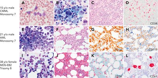 BMs with CMML, AML, and MDS with excess blasts on initial presentation with GATA2 deficiency. (A-D) A 17-year-old healthy male with family history of GATA2 deficiency (c.1017+572C>T) and AML (mother), MDS (aunt), and CMML (grandfather), presented for his initial evaluation. White blood cell counts of 15.6 × 103/μL. (A) Peripheral blood smear with leukocytosis and circulating blasts (6%), monocytosis (1.5 × 103/μL), and left-shifted granulocytes. (B) BM aspirate showing marked megakaryocytic dysplasia with dysplastic myelopoiesis (inset). (C) BM core biopsy was markedly hypercellular. (D) CD34 IHC on the marrow biopsy showed increased blasts. Cytogenetic analysis revealed monosomy 7, and myeloid next-generation sequencing analysis detected ASXL1, SETBP1, and U2AF1 mutations. Findings indicative of CMML. (E-H) A 21-year-old male presented with fatigue and pancytopenia with no history of infections or family history of myeloid malignancy. (E) BM aspirate with sheets of blasts confirmed by flow cytometry as myeloblasts. (F) BM core biopsy was hypocellular for age. (G) CD34 IHC on the marrow biopsy showed marked increase in blasts >50%. (H) CD117 IHC highlighting the blasts. Monosomy 7 detected on cytogenetic analysis. The patient was diagnosed with AML and subsequently found to have a germ line mutation in GATA2 (T354M). (I-L) A 39-year-old female who was a healthy relative of a proband with GATA2 deficiency (R398W), was recently found to be positive for the mutation and presented for evaluation. Peripheral blood counts were normal to slightly decreased. (I) BM aspirate with increased blasts (∼10%). (J) BM core biopsy was normocellular. (K) CD34 IHC showing increased blasts (∼10%). (L) CD61 IHC staining MKs with a few small forms. The patient was diagnosed with MDS with excess blasts. All peripheral blood and BM aspirates were stained with Wright-Giemsa stain at 1000×. Core biopsies were stained with H&E or IHC as indicated. Images were taken using an Olympus BX41 microscope equipped with a DP74 camera using Olympus cellSens software.