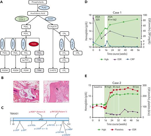 AA metabolism and the clinical characteristics of 2 patients with Ghosal hematodiaphyseal dysplasia syndrome. (A) A schematic diagram of the AA metabolism pathway. AA is released from the membrane phospholipids by PLA2 and is metabolized by COX-1 and −2 enzymes, (green oval) first into the unstable intermediate metabolite PGG2, which is converted to PGH2. PGH2 serves as a substrate for several PG synthases (PGDS, PGES, PGIS, blue ovals) that generate the following proinflammatory PG metabolites: PGD2, PGE2, and PGI2. PGH2 can also be converted to TXA2 through the action of thromboxane synthase (red oval), the gene which is mutated in Ghosal hematodiaphyseal dysplasia syndrome. In addition to the COX-1/2 enzymes, AA is metabolized by 5-LOX (blue oval) to generate various products of hydroperoxyeicosatetraenoic acid, including 5-HETE and leukotrienes, for example, LTE4. (B) Bone marrow biopsy sections for patient 1 have aspiration artifact but show an apparent reduction in marrow cellularity out of proportion to peripheral counts. On the left, H&E-stained section at an original magnification ×10 additionally shows thickened trabeculae (black arrow), and on the right, the H&E-stained section at an original magnification ×20 highlights disorganized osteocytes (black arrow). (C) A schematic diagram of thromboxane synthase A 1, encoded by the TBXAS1, showing the locations of the variants in the 2 patients reported in this manuscript (shown in red, above the diagram), and those from 13 sequenced cases previously reported in the literature (shown in blue, below the diagram). Diagram created using Domain Graph (DOG, version 2.0). D (for Case 1) and E (for Case 2), show. H&E, hematoxylin and eosin; 5-LOX, 5-lipooxygenase; PLA2, phospholipase A2; TXA2, thromboxane A2.