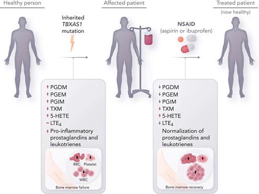 Inherited thromboxane A synthase 1 (TBXAS1) mutations cause GHDD, which leads to enlargement of the long bone diaphysis and bone marrow failure. Affected patients often require frequent transfusion support, and empiric treatment with steroids is sometimes effective. Treatment with NSAIDs (aspirin and ibuprofen) at intermediate to high doses, which inhibits COX-1 and COX-2, reverse aberrant prostaglandin and leukotriene metabolite production in GHDD, leading to restored hematopoiesis. RBC, red blood cell; WBC, white blood cell.