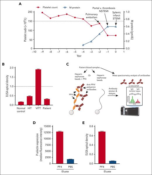 Trending of laboratory variables and affinity purification of the anti-PF4/polyanion antibody. (A) Nadir platelet count (closed circles) and peak serum monoclonal protein (M-protein) levels (open triangles) for each year of clinical data prior to and including the year of presentation to Mayo Clinic are shown on the left and right y-axes, respectively. The lower limit of the normal platelet reference range is depicted by a dotted line (150 × 109/L). (B) HIT, VITT (Ad26.COV2.S-associated), normal control, and patient samples were run in an uncomplexed PF4 (VITT) ELISA. The dotted line represents the positive cutoff of the assay. (C) Experimental scheme for affinity purification of anti-PF4/polyanion antibodies is shown. (D-E) Eluates from PF4/heparin or phosphate-buffered saline (PBS)/control beads were evaluated for their ability to activate PF4-treated platelets (D) and bind PF4/polyanion targets (E). Mean and 1 SD of triplicate measurements are presented in (B), (D), and (E), and (A) presents single measurements of nadir platelet counts and M-protein level. m/z, mass-to-charge ratio; STEMI; ST elevation myocardial infarction; NSTEMI, non-ST elevation myocardial infarction.
