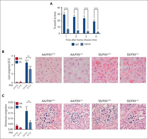 FXII contributes to vascular stasis and congestion in HbSS mice. (A) Townes HbSS mice were implanted with dorsal skinfold chambers. Using intravital microscopy, between 20 and 25 subcutaneous venules were selected and mapped. Mice were treated with IgG or 15D10 (10 mg/kg, IV) 30 minutes before challenge with stroma-free Hb (1 μmol/kg, IV). The preselected venules were marked as flowing or static at 1, 2, 3, and 4 hours after Hb infusion, and the percentage static venules was calculated. n = 4 mice per group, data represent mean ± SEM. ∗∗∗∗P < .0001 vs IgG/SS at each time point by two-way ANOVA. Paraffin sections of livers and kidneys from AA/FXII+/+, AA/FXII−/−, SS/FXII+/+, and SS/FXII−/− mice 4 months after BM transplantation were stained with hematoxylin and eosin. (B) Sinusoidal congestion and (C) glomerular congestion were scored by blinded pathologists. Representative images are shown; n = 4 to 8 mice per group, data represent mean ± SEM. ∗∗P < .01, ∗∗∗P < .001, ∗∗∗∗P < .0001 by two-way ANOVA and Tukey post-hoc test. Asterisks above bar represent difference from HbAA, asterisks above line indicate difference between FXII genotype. Red staining on representative images showed in panels B and C demonstrates presence of RBC within congested vessels. ANOVA, analysis of variance.