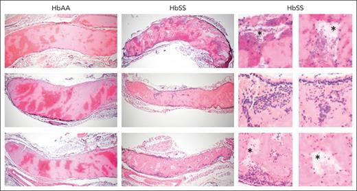 SCD affects morphology of venous clots. Representative, hematoxylin and eosin–stained images of femoral vein clots harvested from HbAA and HbSS mice 1 hour after electrolytic injury, (original magnification ×4). In the clots, areas rich in RBCs stain dark red whereas areas of fibrin and platelets stain light pink. In the enlarged images on the right, asterisks denote acellular empty spaces within the clots; dark blue staining denotes inflammatory cells within the clots.