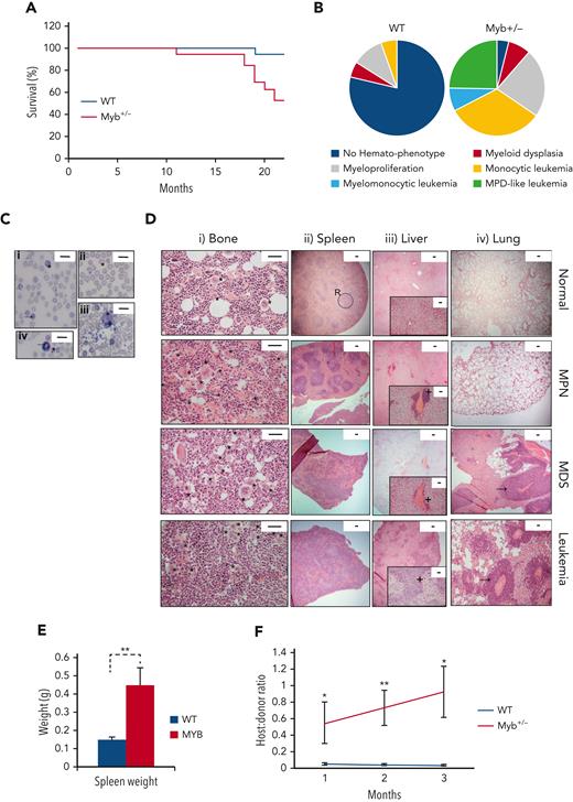 Myb deficiency leads to age-related hematological disease. (A) Kaplan-Meier curve showing the percentage survival of a cohort of aging WT and Myb+/− mice (n = 19 and 17, respectively) over 22 months. Significance was calculated using the log rank test with P = .0035. (B) Pie charts depicting the types of myeloid disease arising with age. (C) Blood smears from diseased mice showing examples of abnormal peripheral blood cells. (i) Target cell erythrocyte (codocyte) (∗). Polychromatic erythrocyte (→). (ii) Teardrop erythrocyte (dacrocyte) (∗). (iii) Micromegakaryocte (∗). (iv) Howell-Jolly body in erythrocytes (∗). Ring-neutrophil (→). Scale bar = 20 μm. (D) Representative sections from tibial bone, spleen, liver, and lung from mice characterized as WT, MPN, MDS, or myeloid leukemia. Scale bars are indicated. (i) Bone section with megakaryocytes (∗) showing an increase in diseased mice. Scale bar = 50 μm. (ii) Spleen sections showing disrupted red and white pulp structure in diseased mice. An example area of white (circle) and red (R) pulp is indicated. Scale bar = 100 μm. (iii) Liver sections showing infiltration of myeloid cells (+). Scale bar = 100 μm (inset: scale bar = 50 μm). (iv) Lung sections showing infiltration of myeloid cells (→). Scale bar = 100 μm. (E) Spleen weight (g) of aging WT and Myb+/− mice at the point of culling (n = 19 and 17, respectively). Significance was calculated using t test P = .006. Data are represented as the mean and SEM. (F) Ratio of host:donor bone marrow cells from WT (n = 4) and mice with myeloid leukemia (n = 6). Whole bone marrow was transplanted into sublethally irradiated (450 Gy) B6.SJL-Ptprca/BoyJ mice. Ratios are calculated by antibody staining of peripheral blood against CD45.1 and CD45.2 antigens at 1, 2, and 3 months after transplant (P = .043, .007, and 0.011, respectively). Data points represent the mean ratios with SEM. SEM, standard error of the mean.