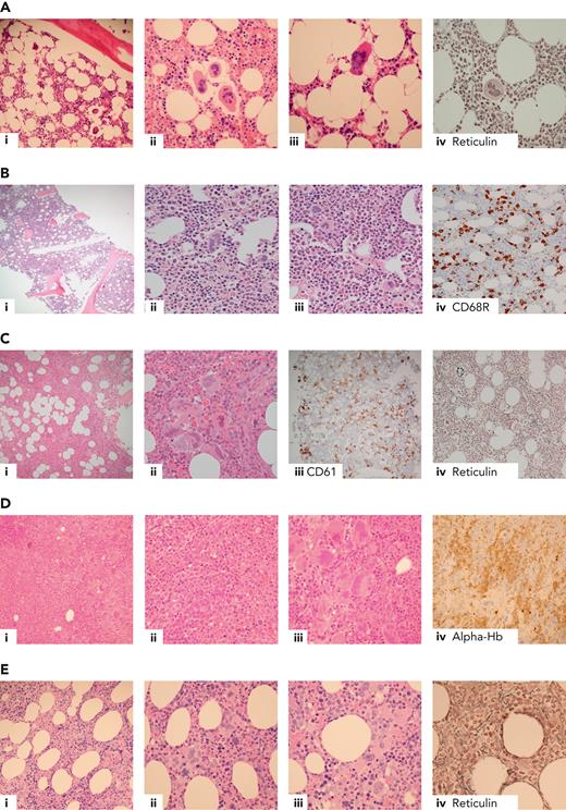 Example cases in the differential diagnosis of ET. (A) Triple-negative ET in a 40-year-old female with thrombocythemia, no mutations detected. Normocellular bone marrow with a mild increase in megakaryocytes (i), occasional loose clusters (ii), and subpopulation of larger megakaryocytes with hypersegmented nuclear morphology (ii-iii) with no evidence of fibrosis (iv). Exclusion of reactive causes of thrombocytosis required to meet diagnostic criteria (Table 2).8,9,16 (B) Reactive thrombocytosis in a 24-year-old female with platelet count of 480 × 109/L, normocellular bone marrow, and no increase in megakaryocytes (i). Occasional large megakaryocytes with hypersegmented nuclei (ii) and most megakaryocytes show normal morphology (iii). CD68R (iv) shows increased macrophage activity. (C) Iron-deficient PV in a 30-year-old female with thrombocytosis, normal hemoglobin, and iron deficient. The combination of hypercellularity (i), megakaryocyte clustering and pleomorphism (ii-iii, respectively), and the WHO classification–based grade-1 fibrosis (iv) favor a diagnosis of iron-deficient PV rather than ET.8,9 (D) MDS/MPN with SF3B1 mutation and thrombocytosis in a 80-year-old female with anemia and thrombocythemia. Hypercellular bone marrow, with erythroid hyperplasia (i, iv, respectively), dyserythropoiesis (ii), and expanded megakaryopoiesis (iii). Megakaryocytes show an MPN-like morphology, and >15% ring sideroblasts on aspirate was observed; JAK2 V617F and SF3B1 mutations detected.8,9 (E) Prefibrotic primary myelofibrosis in a 70-year-old female with leucocytosis and thrombocytosis, JAK2 V617F positive. (i) Hypercellular bone marrow with expanded granulopoiesis and megakaryopoiesis. Megakaryocytes show clustering and include forms with hyperchromatic, hyperlobated nuclei (ii) as well as megakaryocytes with bulbous or cloud-like nuclear morphology (iii), with the WHO classification–based grade 1 reticulin fibrosis (iv).8,9 Hb, hemoglobin; WHO, World Health Organization.