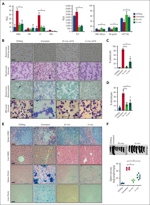 Phenotypic correction of CD46/Townes mice using ex vivo and in vivo approaches at week 16 after treatment. (A) Blood cell analysis of healthy control CD46tg mice (“CD46tg,” n = 3), untreated CD46/Townes mice (“untreated,” n = 3), primary recipient mice at week 16 after transplantation of ex vivo–transduced BM Lin− cells from CD46/Townes mice (“ex vivo,” n = 5), and CD46/Townes mice at week 16 after in vivo transduction (“in vivo,” n = 7). (B) Representative microphotographs of blood cell and BM smears. First panel: smears of total blood cells subjected to a sickling assay; second panel: blood cell smears stained with Giemsa; third panel: staining of blood smears for reticulocytes with brilliant cresyl blue, which stains nuclear remnants of basophilic ribonucleoproteins in reticulocytes (black arrow); fourth panel: BM smears stained with Giemsa. The red arrow marks an undifferentiated proerythroblast. The blue arrow points at more differentiated erythroblasts or reticulocytes. The scale bars are 20 μm. (C) Percentage of sickle cells in blood smears. Each dot represents the percentage in an individual mouse. (D) Percentage of reticulocytes in blood smears. (E) Upper 2 panels: spleen and liver sections stained with hematoxylin and eosin. Lower 2 panels: tissue hemosiderosis visualized using Perls Prussian blue staining. Iron deposition is shown as cytoplasmic blue pigments of hemosiderin in spleen tissue sections. The scale bars are 200 μm. (F) Spleen sizes (upper panel) and spleen weight relative to body weight (lower panel). Each symbol represents an individual mouse. ∗P < .05. Statistical differences were calculated using one-way ANOVA with Šidák’s multiple comparisons test. HCT, hematocrit; Hb, hemoglobin; LY, lymphocytes; MO, monocytes; NE, neutrophils; PLT, platelets; RBC, red blood cells; WBC, white blood cells.