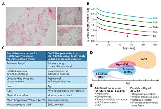 Schematic representation of parameters used in machine learning for diagnosis of AA. (A) Representative bone marrow biopsy (trephine), low power (×4, ×10, ×20 lens objectives), showing hypocellular marrow with absent/reduced hematopoietic cells. (B) Example of a TL report showing a representative patient with a TL in <first centile. (C) The top 7 parameters used in machine learning and the parameters that showed statistical significance in logistical regression analysis. Refer to Figure 4 and supplemental Table 4 in Gutierrez-Rodrigues et al.1 (D) Spectrum of inherited and acquired BMFS, with age distribution and overlap with hypoplastic MDSs. (E) Additional parameters for future model building and potential future utility of AI in AA. HbF, fetal hemoglobin. Professional illustration by Patrick Lane, ScEYEnce Studios.