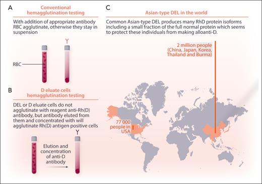 Migration of people with Asian-type DEL to the United States. Conventional blood typing uses combinations of mouse monoclonal antibodies to detect the major Rh protein, “D,” by hemagglutination (A). Donors and patients with the Asian-type DEL mutation make multiple variants of the D protein in reduced amounts, which can be detected by eluting and concentrating the reagent antibodies from their cells and using them to agglutinate reagent RhD+ red blood cells (RBC) (B). Two million such individuals live in China, Japan, Korea, Thailand, and Burma, and tens of thousands live in other countries (C). Professional illustration by Somersault18:24.