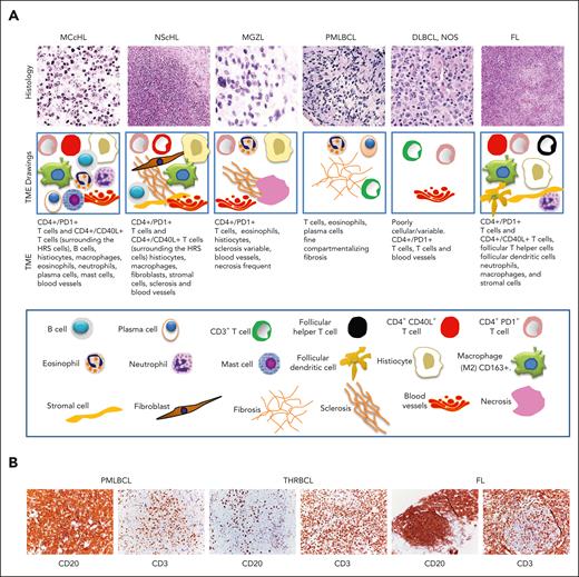 Tumor microenvironment in Hodgkin lymphoma and other B-cell lymphomas. (A) Histology and morphological characteristics of TME of cHL, MGZL, PMLBCL, DLBCL not otherwise specified and FL. Histology images (top row) showing the different subtypes of lymphomas and the corresponding drawings (second row) showing the cell types in their TMEs. As shown in the drawings, the TME in cHL demonstrates variable cellularity, which is different in each subtype. In mixed cellularity cHL, the TME consists of a polymorphous reactive infiltrate of B and T cells, neutrophils, histiocytes, plasma cells, and mast cells. In NScHL, the TME is specifically characterized by fibroblast-like cells and sclerosis. In MGZL, the TME typically comprises histiocytes, irregular sclerosis, and necrosis. In PMLBCL, the TME is variable but usually consists of histiocytes, lymphocytes, and compartmentalizing fibrosis. In DLBCL not otherwise specified (NOS), the TME is diminished but is quite variable; In FLs, the TME is partly similar to that of cHL, although in FL, it is rich in follicular dendritic cells. (third row) the cell types shown in the drawings, and (bottom row) the keys of the cell types. (B) The composite figure shows CD20 and CD3 immunostaining in 2 specific DLBCLs, PMLBCL and T-cell/histiocyte-rich B-cell lymphoma, and FL. In all of these lymphomas, tumor cells are immunostained for CD20, whereas their TME contains reactive infiltrates rich in CD3+ T cells. Topological and quantitative analyses of microenvironmental cells interacting with tumor cells were performed using an unsupervised clustering analysis of the TME. This analysis revealed that the TME in THRLBCL is distinct from cHL and DLBCL NOS with respect to PD-1/PD-L1 expression and spatial organization (spatial immune signature).24 In FLs and DLBCL NOS, which are often resistant to anti–PD-1 therapy,25,26 PD-L1 copy gains are not observed.27,28 It has been speculated that the lower incidence of tumor cell-specific PD-L1 expression in FL and DLBCL NOS, when compared with that in cHL, is compensated for by the higher density of PD-L1+ TAMs to ensure adequate PD-1 engagement for immune evasion.24 Original magnification ×10 (NScHL, FL), ×20 (PMLBCL, DLBCL NOS), and ×40 (MCcHL, GZL) (A) and ×20 (B).