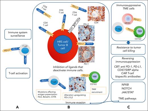 Cross talk between tumor cells and their cellular microenvironment. According to lessons learned from classic Hodgkin lymphoma (cHL), expression of PD-L1 can be found in tumor B cells, and expression of PD-1 is found on microenvironmental T cells in lymphomas with an inflammatory/immune cell-rich microenvironment. PD-1, which acts as an immunomodulatory molecule, is a negative regulator of activated T cells, B cells, and myeloid cells. PD-L1, a ligand of PD-1, is expressed on T cells, B cells, dendritic cells, and macrophages. (A) PD-L1 binds to PD-1 on T cells and regulates their activity. Binding of PD-1 to T cells with PD-L1 and 2 to HRS cells43 inactivates tumor-specific T cells, functioning as a checkpoint used by HRS cells and other tumor B cells to escape immune surveillance and evade immune destruction. (B) Classic HL with PD-L1 upregulation, acquired in HRS cells through highly recurrent copy gains of the chromosomal region containing the PD-L1 locus, is sensitive to PD-1 blockade therapy.12,13,44-46 In cHL and other lymphomas with inflammatory/immune cell-rich microenvironment, PD-L1 might be expressed by tumor cells and TAMs. PD-L1 binds to PD-1 on CD4+ and CD8+ T cells, attenuating the function of T cells and inhibiting the release of cytokines, leading to the immune escape of tumor cells. Following an antilymphoma immune response, lymphoma cells may recruit numerous TAMs and acquire genetic alterations that affect antigen presentation to T cells and upregulate the expression of PD-L1/L2. (C) Blockade of PD-1 and PD-L1 could be a therapeutic approach for enhancing immune cell function. Lymphoma cells might also be responsive to immunotherapy with antibodies that block CD47/SIRP (signal-regulatory protein) α interaction. Immune and inflammatory cell infiltrates in the TME produce molecules that bind to proteins expressed on the tumor cell membranes. The NF-κB, NOTCH1, and JAK-STAT pathways are activated via membrane-bound signaling. These TME pathways promote an inflammatory immune environment and resistance to apoptosis. Tumor infiltration by TAMs, immunosuppressive myeloid cells, and regulatory T cell may be related to the resistance to checkpoint blockade therapy (CBT). The mechanisms of resistance to PD-1 blockade have been identified in solid tumors partly,47,48 whereas they remain largely unknown in lymphoid malignancies. In solid tumors, a heavy infiltration of immune-suppressive myeloid cells can correlate with resistance to checkpoint blockade.49 Therefore, the characterization of the cHL microenvironment with a specific focus on inflammatory and immune cells might provide important information on the mechanisms of response to CBT.11,23 Furthermore, mutational analysis and clonal evolution measured by sequencing circulating cell-free tumor DNA may help identify the genetic determinants of resistance/refractoriness to anti–PD-1 therapy.50-52 Adapted and modified from Carbone and Gloghini.43