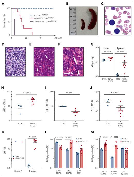 NFIA-ETO2–expressing TP53R248Q/+ hematopoietic cells induce erythroleukemia in mice. (A) Kaplan Meier plot of disease-free mice recipients of NFIA-ETO2–expressing (red line = primary recipients, n = 9; purple line = secondary recipients, n = 8) or CTRL TP53R248Q/+ cells (blue dashed line n = 4). (B) Spleens of a control (left) and a symptomatic mouse (right) that received transplantation with NFIA-ETO2–expressing TP53R248Q/+ cells (right). (C) Wright-Giemsa–stained peripheral blood smear from a diseased mouse showing 2 EBs (original magnification ×100; scale bar, 10 μm). (D-F) Images of H&E-stained sections of BM (D), spleen (E), and liver (F) of diseased mice that received transplantation with NFIA-ETO2–expressing TP53R248Q/+ EBs (original magnification ×40; scale bar, 30 μm). (G) Spleen and liver weight of symptomatic mice that received transplantation with NFIA-ETO2–expressing (red dots; n = 8) or CTRL cells (blue dots; n = 4). (H-J) Peripheral WBC (×109/L) (H), RBC counts (×1012/L) (I), and PLT counts (×109/L) (J) in symptomatic mice that received transplantation with NFIA-ETO2–expressing TP53R248Q/+ (red dots, n = 8) compared with mice that received transplantation with CTRL cells (blue dots; n = 4). (K) Fraction of transduced GFP+ cells (%) before transplantation (T) and at termination of the experiment in mice that received transplantation with NFIA-ETO2- (red dots; n = 8) or CTRL (blue dots; n = 4) EBs. (L) Kit and CD71 surface expression in total BM cells (in percentage) from symptomatic mice that received transplantation with NFIA-ETO2–expressing TP53R248Q/+ cells (n = 8) or vector-transduced control (CTRL) cells (n = 4). (M) CD71 and Ter119 surface expression in total BM cells (in %) from symptomatic mice that received transplantation with NFIA-ETO2–expressing TP53R248Q/+ cells (n = 8) or CTRL cells (n = 4). (N) Colony formation by GFP+ and GFP− EBs harvested from symptomatic mice that received transplantation with NFIA-ETO2–expressing TP53R248Q/+ cells. Shown are absolute numbers of colonies from first to the sixth consecutive plating in MC. (O) Kit and CD71 surface expression in cells (in %) from the second MC plating of GFP+ cells from symptomatic mice that received transplantation with NFIA-ETO2–expressing TP53R248Q/+ cells. (P) Quantification of Tp53 alleles in BM cells from WT (purple dots), TP53R248Q/− (pink dots), and from symptomatic mice that received transplantation with NFIA-ETO2–expressing TP53R248Q/+ cells (orange dots) assessed via PCR analysis. Values are presented as individual points; bar graphs represent the mean value of independent biological replicates (n); and error bars are standard error of the mean. Statistical significance was tested with unpaired two-tailed t tests. H&E, hematoxylin and eosin.