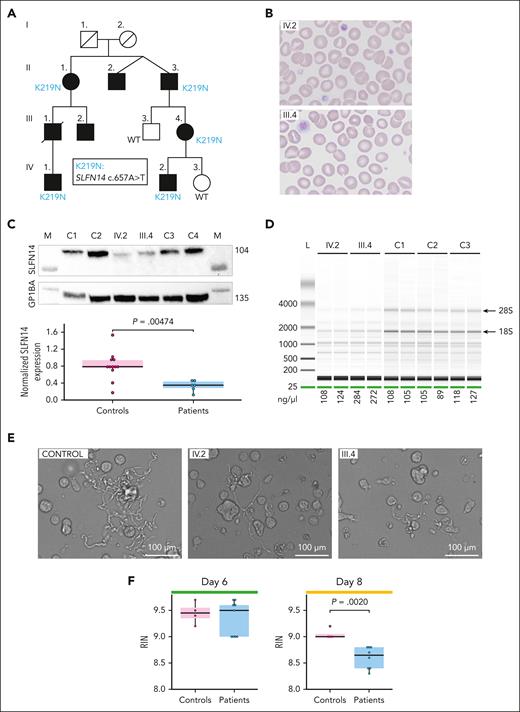 Pedigree and platelet characteristics of SLFN14 K219N carriers. (A) Pedigree showing affected family members (black symbols) with TP. The presence of the K219N SLFN14 variant is indicated when tested. (B) Peripheral blood smears (May-Grünwald-Giemsa stain; original magnification ×500) of patients IV.2 and III.4 showing platelet anisocytosis with the presence of small and large, hypogranular, platelets. Note the presence of microcytic erythrocytes. (C) Representative immunoblot analysis of SLFN14 protein expression in platelets from patients IV.2 and III.4 and 2 unrelated age- and gender-matched controls for each patient (top). The expression of GP1BA was used as a loading control and for normalization. Marker lanes are indicated as M. Quantification of triplicate immunoblots show a significant reduction in SLFN14 expression in platelets from patients with SLFN14 compared with 4 healthy controls (bottom). Boxplots represent the middle 50% of the data points, with 25% outliers as whiskers and the mean as a black horizontal line. All individual data points were added as dots to the graph. Three technical replicates were performed for each sample. P values were determined using the Wilcoxon test. (D) Representative electrophoresis image showing rRNA degradation of the 28S and 18S peaks (arrows) for platelet RNA samples of patients IV.2 and III.4, compared with platelet RNA from 3 unrelated controls. The concentration of total RNA (ng/μL) for the different samples was added below the figure. (E) Representative brightfield microscopy images illustrating proplatelet formation in blood-derived stem cell cultures after 8 days of MK differentiation showing shorter proplatelets with reduced ramification in cultures from patients IV.2 and III.4, compared with the control. Scale bar, 100 μm. (F) Quantification of the RIN values obtained for RNA samples from days 6 and 8 MK differentiated from blood-derived stem cells of patients IV.2 and III.4 vs a control (4 technical replicates for control days 6 and 8, patient IV.2 days 6 and 8, and patient III.4 day 8, 5 technical replicates for patient III.4 day 6). Statistical analyses were performed using the Wilcoxon test.