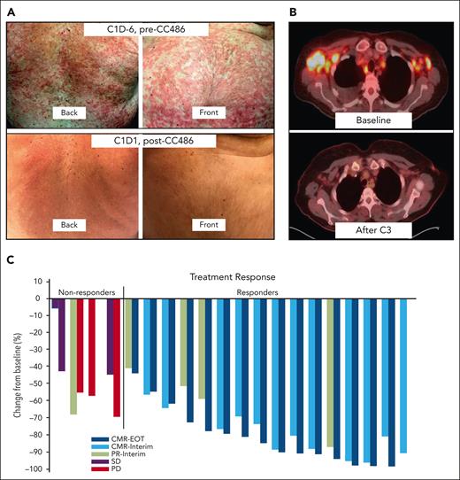 Treatment responses. (A) Cutaneous response after 7-day CC-486 priming before CHOP chemotherapy in a study subject with biopsy-proven skin involvement by AITL. (B) PET/CT response at interim assessment after treatment with 3 cycles of CC-486 plus CHOP in a study subject. (C) Waterfall plot of interim and end-of-treatment response assessment in 20 evaluable subjects. PET/CT, positron emission tomography/computed tomography.