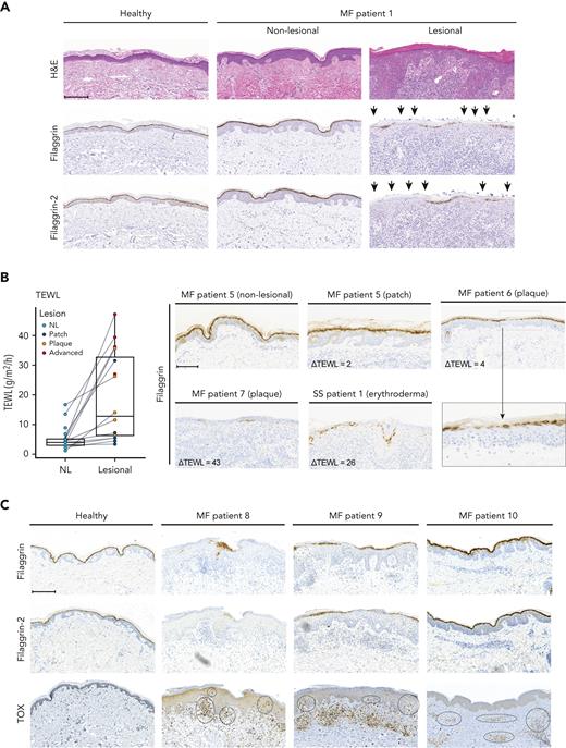 Filaggrin and filaggrin-2 protein expression is reduced in lesional MF skin, TEWL is increased, and epidermal immune infiltrates correlate with the reduced expression levels. (A) Lesional and nonlesional (NL) skin biopsies obtained from a patient with MF (MF1), and a healthy donor, were stained for hematoxylin and eosin stain (H&E), filaggrin, and filaggrin-2. The arrowheads highlight areas of deficient filaggrin and filaggrin-2 protein expression. (B) TEWL (g/m2 per hour) measurements were performed for anatomically matched lesional and nonlesional sites in 12 patients with patches, plaques, or advanced lesions (tumor/erythroderma) (left). Some patients had multiple lesions that were analyzed. Lesional skin biopsies from 3 patients with MF and 1 with Sézary syndrome (MF5, MF6, MF7, and SS1) and nonlesional skin biopsy from patient MF5 were stained for filaggrin (right). Micrograph close-up for patient MF6 illustrates areas that lack filaggrin expression. ΔTEWL values (subtracting nonlesional from lesional values) were given for each of the patients. (C) Lesional skin site biopsies obtained from 3 patients with MF (MF8, MF9, and MF10) and a biopsy from a healthy donor were stained for filaggrin, filaggrin-2, and TOX. Areas of positive TOX staining in the epidermis/dermis are highlighted by black circles. Images are scanned by the Zeiss Axio Scan.Z1 with original magnification ×20 for all panels. Scale bars; 200 μm. Close up; 300%.