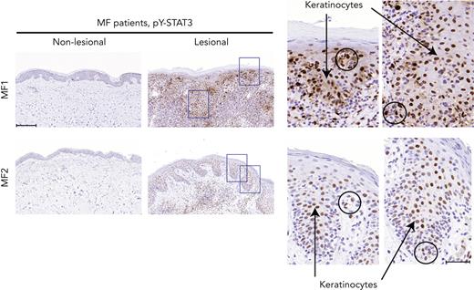 pY-STAT3 is induced in lesional MF skin. Lesional and nonlesional skin site biopsies obtained from 2 patients with MF (MF1 and MF2) were stained for pY-STAT3. Micrograph close-ups illustrate areas with pY-STAT3–positive keratinocytes (arrows) close to areas with immune infiltrates, potentially pY-STAT3–positive malignant T cells (circles). Images are scanned by the Zeiss Axio Scan.Z1 with original magnification ×20. Scale bars; 200 μm and 50 μm for close-ups.