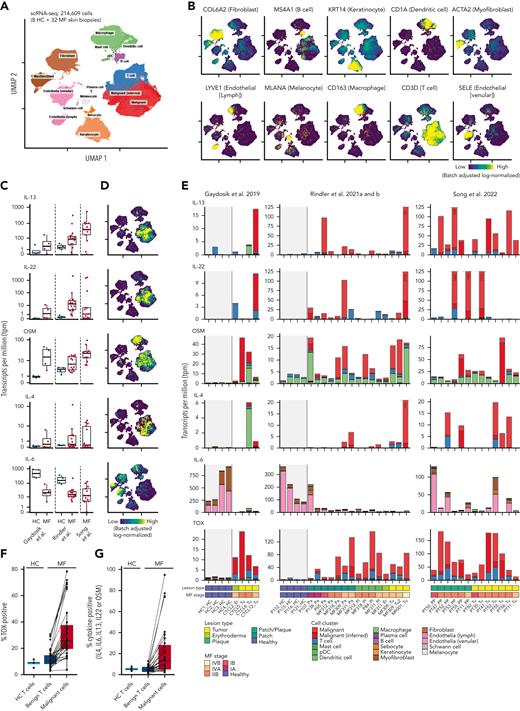 IL-13, IL-22, OSM, and IL-4 are expressed in lesional skin from patients with MF. scRNA-seq samples from 8 healthy controls (HCs) and 32 MF biopsies across 4 publicly available studies50-52,62 were integrated and batch corrected using SCVI. (A,B) Cell-type annotation visualized on uniform manifold approximation and projection (UMAP) showing distinct clustering of major cell types annotated by the expression of lineage markers. (C) Quantification of IL-13, IL-22, OSM, IL-4, and IL-6 transcripts across each sample divided into HC and MF. Values denote the number of unique cytokine transcripts per million total transcripts (tpm). (D) UMAP visualization of which cell clusters express each cytokine. Owing to sparsity of the transcripts, positive cells are plotted on top. (E) Quantification of IL-13, IL-22, OSM, IL-4 IL-6, and TOX transcripts across cell clusters within each sample. Bars depicting samples with extreme expression were truncated to allow visualization, together with samples with lower expression levels. The truncation is indicated by dashed lines, and numbers in bars denote tpm for the given bar at full height. Gray areas mark HC samples. The samples were ordered by study and disease status (HC vs MF), lesion type, and MF stage as shown at the bottom. Multiple biopsies across multiple lesion types are included for some patients and can be identified by the sample names below the plot. Fraction of cells expressing at least 1 transcript of TOX (F) or IL-13, IL-22, OSM, IL-4, or IL-6 (G) within T cells from HC, and benign T cells, or malignant cells from MF biopsies. Lines link values from matched benign T cells and malignant cells from the same sample. pDC, plasmacytoid dendritic cell.