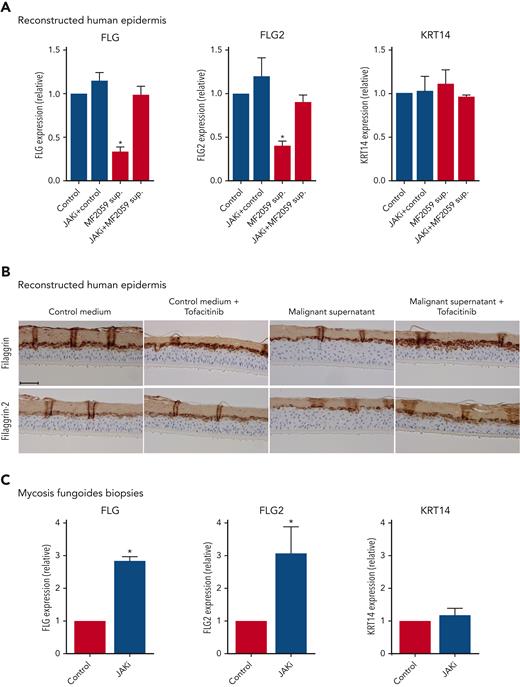 JAK inhibition blocks tumor cell–induced reduction of filaggrin and FLG2 in keratinocytes and in ex vivo MF skin. (A) RHE samples were cultured for 24 hours with the malignant MF2059 T-cell line in the presence of either 1 μM JAK inhibitor (tofacitinib) or dimethyl sulfoxide (DMSO) (control). (B) RHE samples were cultured in the presence of supernatants for 48 hours with 1 μM tofacitinib or DMSO. (C) Skin biopsies from MF plaques were cultured with 1 μM tofacitinib or DMSO for 72 hours. mRNA expression was analyzed by qPCR using β-actin as a reference gene in panels A and C. Gene expression was given as relative expression. Protein expression was analyzed by IHC for RHE samples. The RHE samples were stained for H&E, filaggrin, and filaggrin-2. Images are scanned by the Zeiss Axio Scan.Z1 with original magnification ×20. Scale bar; 50 μm. n = 3, ∗P < .05.
