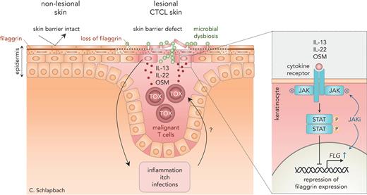 Cytokines from malignant T cells in CTCL downregulate filaggrin and suppress skin barrier function. In healthy skin, filaggrin promotes integrity of the skin barrier. In cutaneous T-cell lymphoma, malignant T cells produce the cytokines IL-13, IL-22, and OSM, which bind to cytokine receptors on surrounding keratinocytes. This activates the JAK-STAT pathway and downregulates filaggrin expression. Filaggrin deficiency in the epidermis causes defects in the skin barrier, which, in turn, promotes inflammation, microbial dysbiosis, and infections, and may even fuel malignant T-cell growth. JAK inhibitors, such as tofacitinib, reverse these effects and can help restore skin barrier function in CTCL.