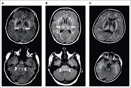 Examples of MRI changes during severe ICANS. Brain MRI during severe ICANS may rarely demonstrate symmetric T2/FLAIR hyperintensities in dorsal medial thalami (top; arrows) and tectal plate (bottom; arrowheads) resembling imaging changes associated with Wernicke encephalopathy. (A) MRI images from an adult patient with grade 4 ICANS. (B) MRI images from a pediatric patient with grade 4 ICANS. (C) Images from a pediatric patient with diffuse cerebral edema.