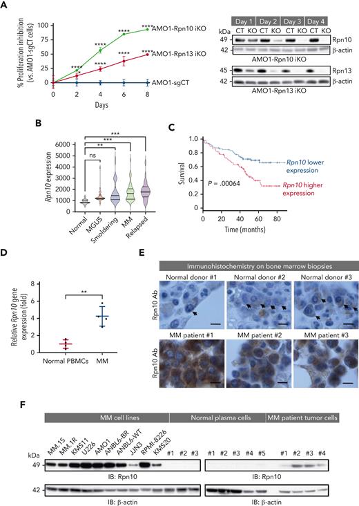 Characterization of ubiquitin receptor Rpn10 in MM cells. (A) Dox-inducible Cas9 AMO1 cells were made by infecting AMO1 cells with lentivirus-packaged inducible Cas9 plasmid followed by G418 selection. These cells then were infected with either control single-guide RNA (sgRNA) or Rpn13- or Rpn10-targeted sgRNA and selected with puromycin to generate stable iKO cells. Cell growth was evaluated by a CellTiter-Glo (CTG) assay. Immunoblot showing Rpn13 and Rpn10 expression, respectively, in corresponding KO cells to test the KO efficiency. Data are shown as the mean ± standard deviation (SD) of triplicates. (B) Gene expression data were collected using Affymetrix Human Genome U133A array platform. Rpn10 expression in the different stages of MM development, including normal CD138+ cells (n = 15), monoclonal gammopathy of undetermined significance (MGUS) (n = 22), smoldering (n = 24), newly diagnosed MM (n = 69), and relapsed MM (n = 28) (data accession number GSE6477). (C) Kaplan-Meier plots of Rpn10 expression vs overall survival of patients with MM. Analysis was performed using samples from 170 newly diagnosed patients with MM (data accession number GSE39754; P = .0064). (D) Total cellular RNA from purified CD138+ cells from BM of patients with MM or normal healthy donor PBMCs was subjected to reverse transcription polymerase chain reaction analysis, followed by real-time polymerase chain reaction using primers designed to recognize sequences internal to Rpn10 (mean ± SD, n = 4). (E) Immunohistochemistry analysis of BM biopsies from normal donors and MM patients showing Rpn10 expression (scale bar, 5 μm). (F) Protein lysates from a panel of MM cell lines, normal PCs, or primary cells from patients with MM were subjected to immunoblotting (IB) using Rpn10 and β-actin antibodies. Ab, antibody; CT, control; ns, not significant.