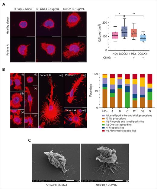 DOCK11 mutations lead to abnormal cell morphologies. Spreading assays with different lymphocytes subsets. (A) T-cell morphologies after spreading. Blue color corresponds to 4′,6-diamidino-2-phenylindole staining (nucleus). Red color corresponds to actin staining. Each patient is represented by a different symbol: patient A (⁕), patient B (●), patient C (■), patient D1 (×), patient D2 (★), patient F (∇), and patient G (o). Coverslips were coated with either poly-L-lysine (i); poly-L-lysine, anti-CD28, and anti-CD3 (0.1 μg/mL) antibodies (ii); or poly-L-lysine, anti-CD28, and anti-CD3 (1 μg/mL) antibodies (iii). Scale is set at 10 μm. Cell area was measured with or without CN02 treatment (CDC42/RAC1 activator). Nonparametric Kruskal-Wallis test was performed (∗P < .05). (B) B-lymphoblastic cell lines morphologies after spreading. Several morphologies were observed: cells with no protrusion, cells spread along 1 axis, cells with fine protrusions (filopodia), cells with lamellipodia, and cells presenting both lamellipodia and filopodia. Cells from patients presented abnormal protrusions. Repartition of each morphology types is shown. Scale is set at 10 μm. (C) Morphologies of mature MDDCs from HD, using either a scramble shRNA or a DOCK11-shRNA, after stimulation with lipopolysaccharide (LPS) 100 ng/mL for 24 hours, were observed using scanning electron microscopy. Scale is set at 5 μm.