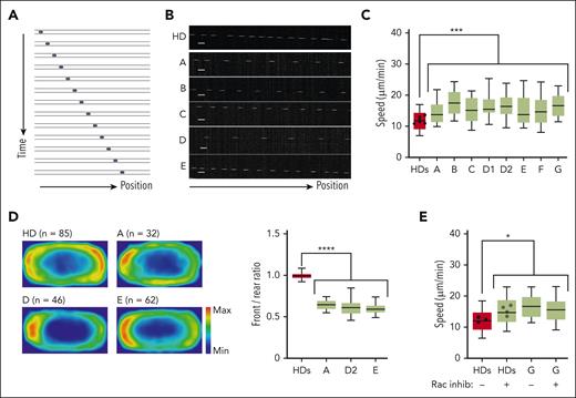DOCK11 is needed for human leukocytes migration under confinement. Analysis of human HD and DOCK11-deficient T-cell migration in fibronectin-coated microchannels. Boxes include the 80% of the points, and bars represent the higher and lower 10% of points. (A) Representative montage of the change of position over time of human T-cell blast migrating inside microchannels of 4 × 5 μm with a timelapse of 2 minutes. (B) Representative kymograph of T-cell blast from HD (top panel) and DOCK11 patients (A-E, lower panels as indicated). (C) Mean instantaneous speed of HD and DOCK11 T-cell blasts migrating in 4 × 5 μm microchannels. Results from n = 2 independent experiments with each condition. Unpaired nonparametric Mann-Whitney test was used to evaluate statistical significance between the mean speeds of cells from controls and patients (∗P < .05; ∗∗P < .01; ∗∗∗P < .001). (D) Density maps representing the enrichment of actin in HD and DOCK11-deficient T cells migrating in 8 × 5 μm microchannels. Cells were allowed to migrate, fixed with 4% paraformaldehyde (PFA) to maintain the polarized morphology, and stained with phalloidin to visualize F-actin. The density maps were generated by averaging the signal from HD (n = 85), patient A (n = 32), patient D (n = 46), and patient E (n = 63) cells. Quantification of the signal intensity on density maps presented as front/rear ratio per cell. One-way ANOVA was used to evaluate statistical significance. (E) Mean instantaneous speed of HD and DOCK11 T-cell blasts (patient G) migrating in 4 × 5 μm microchannels, with or without RAC inhibitor treatment. Results from n = 2 independent experiment with each condition. One-way ANOVA test was used to evaluate statistical significance. Unpaired nonparametric Mann-Whitney test was used to evaluate statistical significance between the mean speeds of cells from controls and treated controls, patients and patients who were treated (∗P < .05).
