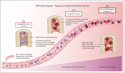 ERCC6L2 disease. Characteristic features of ERCC6L2 disease are illustrated on a 3-phase continuum. In phase 1, individuals present with hypocellular BM with or without small TP53 mutated clonal hematopoiesis. Phase 2 depicts disease acceleration, including BMF, with increasing (possible biallelic) TP53 mutations progressing toward myeloid malignancy. Phase 3 represents overt HM with complex karyotype. PB, peripheral blood; M6, French-American-British subtype of acute erythroid leukemia. Figure created with BioRender.com.
