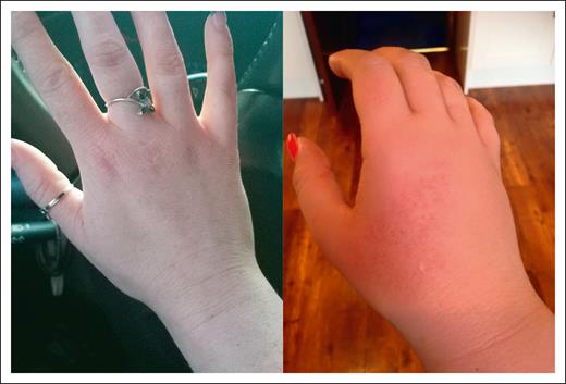 Cutaneous manifestations of phototoxic reactions in protoporphyria. (A) Mild cutaneous edema during a phototoxic reaction. (B) Severe cutaneous edema with petechiae during a phototoxic reaction. Note: in protoporphyria, visible cutaneous changes may not be present, even during severely painful phototoxic reactions.