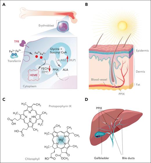 Production of protoporphyrin and chemical structure. (A) Protoporphyrin is primarily produced within the erythroblast in the bone marrow. Iron enters the cell through the transferrin receptor (TFR) and is converted from the ferric (Fe3+) to the ferrous (Fe2+) form. The formation of heme requires insertion of Fe2+ into protoporphyrin, which is catalyzed by FECH. XLP is caused by gain-of-function variants in ALAS2, and EPP by loss-of-function variants in FECH. (B) Protoporphyrin (depicted in purple) is photoreactive and can cause burning, itching, and pain of the skin. (C) The chemical structure of protoporphyrin (left) and chlorophyl (right) are similar. (D) Plasma protoporphyrin (depicted in purple) enters the liver from plasma and can cause liver damage and protoporphyrin-containing gallstones. PPIX, protoporphyrin IX.