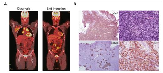 Evaluation of a patient with newly diagnosed T-LLy. (A) PET-CT at diagnosis (left) and EOI (right). (B) Typical histologic and immunohistochemical findings in a patient with T-LLy. Small round blue cells are seen histologically. Immunohistochemical analysis reveals cytoplasmic CD3 and TDT positive, CD20 negative.