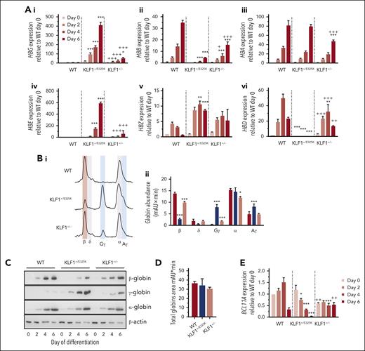Altered expression of globin subunits in KLF1+/E325K cells. (A) Expression of (i) HBG, (ii) HBB, (iii) HBA, (iv) HBE, (v) HBZ, and (vi) HBD via qPCR. (B) Analysis of β-globin (β), δ-globin (δ), Gγ-globin (Gγ), α-globin (α), and Aγ-globin (Aγ) abundance in WT KLF1+/E325K, and KLF1+/− cells on day 6 of differentiation via reverse-phase high-performance liquid chromatography (RP-HPLC); (i) Representative chromatograms and (ii) quantification of chromatogram peak areas (mAU×min; mean ± SD, n = 3; ∗P < .05; ∗∗∗P < .001). (C) Western blots of WT, KLF1+/E325K, and KLF1+/− cells probed with antibodies of β-, γ-, and α-globin, with β-actin as a loading control (representative of 3 biological repeats). (D) Total globin abundance in WT, KLF1+/E325K, and KLF1+/− cells on day 6 of differentiation determined via RP-HPLC as in panel Bii (mean ± SD; n = 3). (E) Expression of BCL11A in WT, KLF1+/E325K, and KLF1+/− cells during expansion (day 0) and on days 2, 4, and 6 of differentiation, determined via qPCR (mean ± SEM; n = 3; ∗P < .05, ∗∗P < .01, and ∗∗∗P < .001 for WT vs KLF1+/E325K; +P < .05, ++P < .01, and +++P < .001 for WT vs KLF1+/−).
