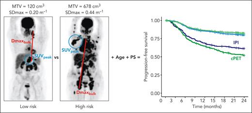 In the clinical PET (cPET) radiomics model, the combination of metabolic tumor volume (MTV), peak standardized uptake value (SUVpeak), maximum distance between the largest lesion and its most distant lesion (Dmaxbulk), patient age, and performance status (PS) outperformed the standard International Prognostic Index (IPI) in identifying the group of patients with diffuse large B-cell lymphoma (DLBCL) with the most unfavorable prognosis. SDmax, maximum standard deviation. The left side of the figure is adapted from an image supplied by M. Meignan with permission. The right side is modified from Figure 3 in the article by Eertink et al that begins on page 3055. Professional illustration by Patrick Lane, ScEYEnce Studios.
