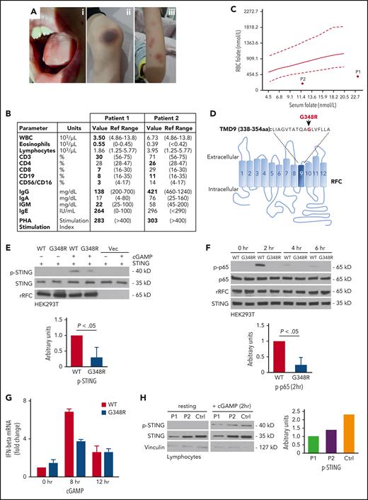 Patient clinical presentation and aberrant activation of stimulator of interferon genes (STING) and NF-κB pathway by G348R recombinant RFC (rRFC). (A) Oral lesions (i) and dark skin discoloration of the knee (ii) and arm (iii) of P1. (B) Immunologic characteristics prior to folate supplementation. Phytohemagglutinin stimulation index reflects values during supplementation. (C) Serum and red blood cell (RBC) folate levels in P1 and P2 during supplementation (ages 8 and 5 years, respectively) demonstrating low RBC folate levels (below the fifth percentile) despite normal serum levels. The solid line represents median and dotted lines represent 5th and 95th percentile concentrations of RBC folate in healthy controls.10 (D) Schematic diagram of the folate and CDN transporter RFC, showing 12 TMDs and the intracellular N-terminus and C-terminus. The G348R mutation affects the ninth transmembrane domain. (E) HEK293T cells expressing wild-type (WT) rRFC, G348R rRFC (G348R), or plasmid vector control (Vec) alongside STING were coincubated in the presence/absence of the cyclic dinucleotide 2’3’-cGAMP (10 μg/mL, 2 hours). Phosphorylation of STING (p-STING) was assessed by Western blotting. The G348R variant induced less STING phosphorylation. The G348R variant induced less STING phosphorylation (bottom), as quantified by densitometry (mean ± standard deviation of 4 independent experiments; 2-tailed Mann-Whitney test). (F) Induction of p65 phosphorylation (p-p65) was impaired following 2’3’-cGAMP incubation in G348R compared with WT rRFC expressing HEK293T cells, as quantified by densitometry (mean ± standard deviation of 3 independent experiments; 2-tailed Mann-Whitney test). (G) Downstream induction of IFN-β, assessed by quantitative polymerase chain reaction, revealed impaired messenger RNA (mRNA) gene expression in G348R expressing HEK293T cells compared with WT (replicates n = 3). (H) Incubation of patient lymphocytes (P1, P2) with 2’3’-cGAMP (40 μg/mL) resulted in reduced STING phosphorylation compared with the healthy controls (Ctrl). Results are normalized against total STING protein levels (bottom). IgG, immunoglobulin G; PHA, phytohemagglutinin; WBC, white blood cell.