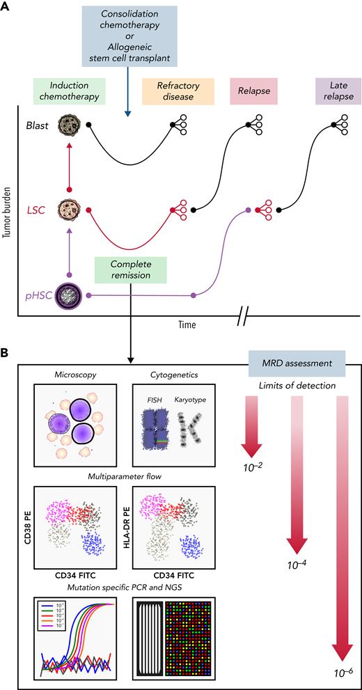 Clinical course for a patient with AML who is refractory or eventually relapses. (A) Patients with AML present with high leukemia blast burden (brown), receive induction chemotherapy, and often enter complete remission. Some patients have refractory disease, and most patients who achieve complete remission ultimately relapse. Patients who are refractory to induction therapies never clear their disease, as assessed by morphology. Those who enter complete remission often have persistent measurable residual disease (MRD), below levels detectable by morphologic analysis. These patients relapse, with variable clonal dynamics, but often have an expanded LSC (red) compartment. Those who relapse late may have had persistent pHSCs (purple) that reevolved into AML. (B) MRD can be assessed by morphology using microscopy (detection limit, 10−2 cells), cytogenetics (10−2 cells), multiparameter flow cytometry (10−4 cells), or mutation-specific polymerase chain reaction (PCR) or next-generation sequencing (NGS; 10−6 cells). FISH, fluorescence in situ hybridization; FITC, fluorescein isothiocyanate; PE, phycoerythrin.