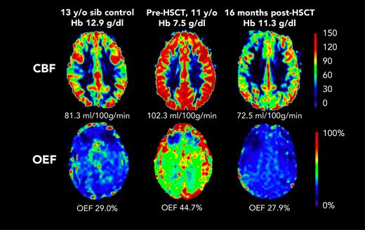 Representative maps from participant F before HSCT (age 11 years) and after HSCT (age 12 years). CBF and OEF were elevated at baseline, and were similar to those of a sex–matched, 13-year-old control participant, 1 year after curative HSCT. sib, sibling.
