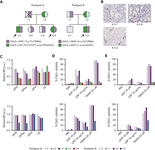 Patients carrying GALE variants showed giant and/or grey platelets in blood films and impaired granules secretion. (A) Family segregation of the variants affecting GALE identified by whole-exome sequencing. Probands are indicated with black arrows. Partially filled symbols in purple or green represent heterozygous status for the indicated GALE variant. (B) Representative peripheral blood films from probands of the 2 pedigrees after May-Grunwald Giemsa staining (×100). Red and black arrows indicate grey and giant platelets, respectively. (C) GPs expression in control and patients, assessed by flow cytometry with fluorescent-labeled antibodies anti-CD42a, CD42b, GPVI, and CD61. The MFI of each antibody, standardized by size (FSC) and relative to the control sample, is represented. (D-E) Platelets from healthy control and family members were stimulated with agonists in the presence of appropriate monoclonal antibodies to assess (D) alpha granules secretion (anti-CD62P), (E) dense granules secretion (anti-CD63) evaluated by flow cytometry. Plots show the percentage of positive platelets. a.u., arbitrary units; ADP, Adenosine diphosphate; CRP; collagen-related peptide; MFI, mean fluorescence intensity; PBS; phosphate-buffered saline; TRAP; thrombin receptor activator peptide.