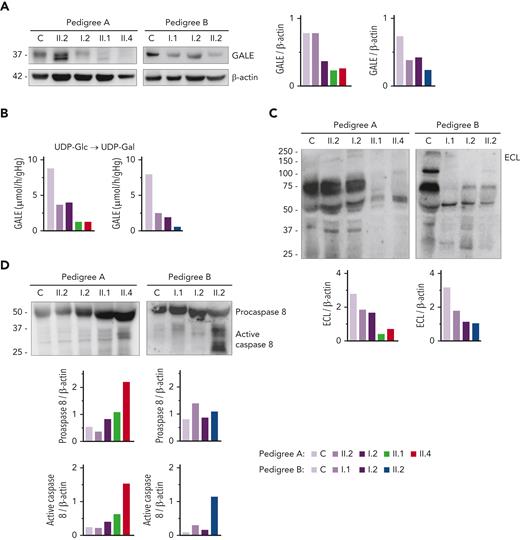 GALE variants associated with reduced GALE protein levels, impaired enzymatic activity, platelet hypoglycosylation, and increased apoptosis. (A) Western blotting from platelet lysates of patients from both pedigrees, unaffected relatives, and controls. Membranes were blotted with anti-GALE and anti-β-actin as an internal control. A.II.2 presented total levels of GALE protein similar to controls, but 2 GALE bands with different electrophoretic mobility were observed (top, GALE-WT; bottom, GALE p.Thr150Met), whereas A.I.2 displayed a 50% reduction of total GALE protein. Probands from pedigree A (II.1 and II.4) showed reduced protein levels (50%) and a tiny band corresponding to GALE p.Thr150Met. Individuals from pedigree B: I.1, I.2, and II.2 showed reduced total GALE protein levels (51%, 65%, and 35%, respectively) vs control. (B) Enzymatic activity of UDP-galactose-4-epimerase assessed in members of pedigrees A and B. The activity of a healthy control was evaluated in parallel. Probands of both families showed a sharp reduction in the GALE enzymatic activity (A.II.1, 15%; A.II.4, 15%; and B.II.2, 7.5%), whereas heterozygous carriers in both families displayed a moderate reduction (A.II.2, 42%; A.I.1, 45%; B.I.1, 31%; and B.I.2, 24%). (C) To assess the glycosylation profile, platelet lysates were probed with lectin ECL, which specifically binds to LacNAc, a dimer of N-acetyl-glucosamine and galactose molecules. β-actin staining, shown in panel A, was used as an internal control. A sharp decrease in ECL binding was found in all probands, less pronounced in heterozygous carriers of a single GALE variant. (D) Platelet lysates were probed with antibodies against procaspase 8 (56 kDa) (top band) or the active-cleaved form of caspase 8 (bottom bands). β-actin (shown in panel A) was the internal protein control. Proband from pedigree A displayed increased procaspase 8 and active caspase 8 level, whereas in the proband from the pedigree B only the active caspase 8 was increased. Band intensities were quantified by densitometric analysis using the ‘Image J’ software. ECL, Erythrina crista-galli lectin; LacNAc, N-acetyl-lactosamine; UDP-Glc, UDP-glucose; UDP-Gal, UDP-galactose.