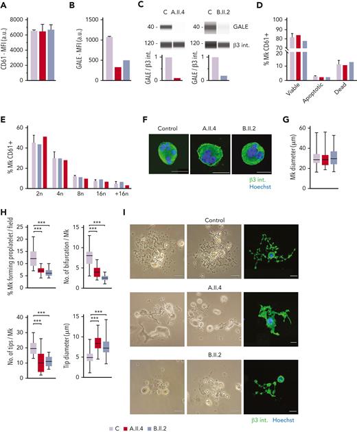 MK culture from probands carrying GALE p.Lys78ValfsX32, p.Thr150Met, p.Val128Met, and p.Leu223Pro variants showed normal polyploidization and maturation but impaired proplatelet formation. MKs were differentiated from peripheral blood progenitor cells from probands A.II.4 and B.II.2 through a 14-days culture, in parallel with healthy controls. (A) MK differentiation assessed as CD61+ cells were measured by MFI by flow cytometry. (B) MFI of GALE, evaluated by flow cytometry, in permeabilized MKs from controls, and probands A.II.4 and B.II.2. Data was relativized with 1 control value. (C) Immunoblotting of MK lysates. Control, A.II.4, and B.II.2 samples were probed with anti-GALE and anti-β3 integrin (internal control). (D) Assessment of MK viability and apoptosis rates at the end of the culture using Annexin V–propidium iodide(PI) labeling. The percentage of CD61+ MKs that are negative for both markers (viable cells), Annexin V+ PI− (apoptotic cells), and double-positive (dead cells) is represented. (E) Percentage of polyploid MKs after PI labeling. (F) Representative images of mature and polynuclear MKs labeled with an anti–β3 integrin antibody (green fluorescence). Hoechst (blue) was used for counterstaining nuclei. Scale bars, 20 μm. (G) Diameter measurement of MK from A.II.A, B.II.2, and healthy controls, in fibrinogen-coated coverslips (n = 100). (H) Characterization of impaired proplatelet formation in fibrinogen-coated coverslips in probands A.II4 and B.II.2 vs control, (1) Rate of proplatelet formation measured as the proportion of MKs displaying ≥1 proplatelet with respect to the total number of MKs; (2) Number of bifurcations of proplatelet shafts per MK; (3) Number of proplatelet-free ends (tips); (4) Diameter measurement of proplatelet-free ends (tips) from A.II.4, B.II.2, and healthy control (n = 100). Box and whiskers graphs are shown. The central line represents the median value, whereas percentiles 25 to75 is included in the box. Whiskers represent the minimum and maximum values. (I) Representative image of proplatelet formation in optical and immunofluorescence microscope. MKs was plated on fibrinogen-coated coverslips and incubated for 16 hours at 37°C and 5% CO2. Cells were stained with an anti-CD61 antibody (green). Hoechst (blue) was used for counterstaining nuclei. Scale bars, 20 μm. ∗∗∗P < .001; 2-tailed Student t test.