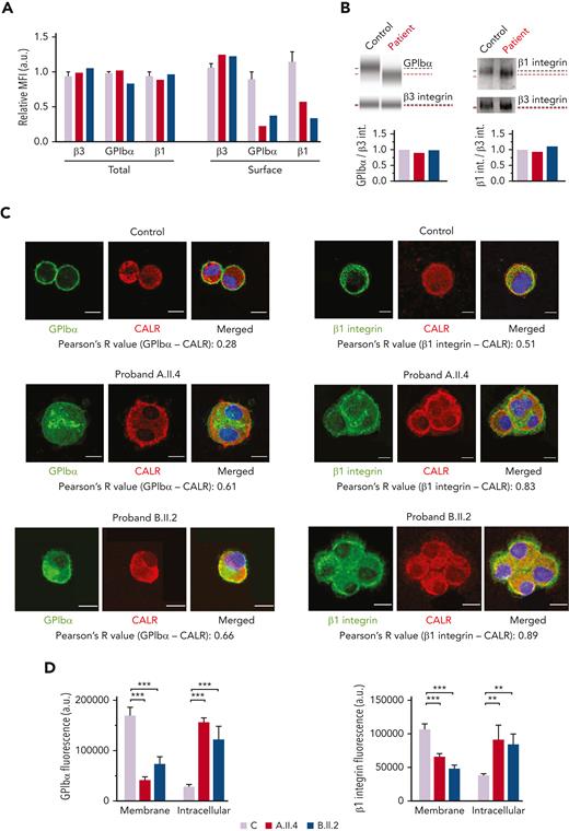 MKs from probands carrying GALE variants displayed impaired GPIbα and β1 glycosylation and externalization. MKs were differentiated from peripheral blood progenitor cells (probands A.II.4 and B.II.2) through a 14-days culture, in parallel with healthy controls. (A) MFI of β3 integrin (anti-CD61), GPIbα (anti-CD42b), and β1 integrin (anti-CD29) in permeabilized MKs (total levels) and nonpermeabilized MKs (surface levels) from controls, A.II.4, and B.II.2 are represented. Data were normalized against 1 control value. (B) Representative analysis of the automized immunoblotting of GPIbα and Western blotting of β1 integrin from a healthy control and proband B.II.2. Red dotted lines highlight bands of lower molecular weight in MKs from patients. Densitometry analysis demonstrated comparable levels of total proteins between patients and controls. β3 integrin was used as an internal control. (C) Representative image of control, A.II.4, and B.II.2 MKs. Cells were cytospinned and stained with anti-GPIbα or anti-β1–integrin antibodies (green). The ER was stained with anti-calreticulin (red fluorescence). Hoechst (blue) was used for counterstaining nuclei. Pearson’s R values indicate the colocalization rate between GPIbα or β1 integrin with calreticulin in control and probands A.II.4 and B.II.2 MKs. (D) Fluorescence intensity distribution of GPIbα and β1 integrin in control vs patients. Control MKs presented a major distribution of GPIbα and β1 integrin in the membrane, with reduced intracellular levels, whereas patients’ fluorescence distribution was mainly intracellular. Scale bars, 10 μm. ∗∗∗P < .001; ∗∗P < .01; 2-tailed Student t test. CALR, calreticulin.