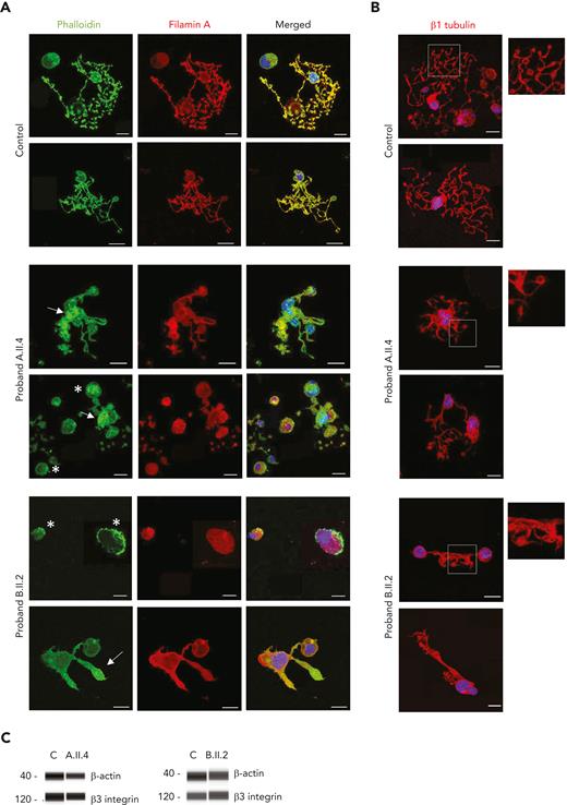 GALE p.Lys78ValfsX32, p.Thr150Met, p.Val128Met, and p.Leu223Pro variants impaired actin and filamin A distribution among the MK cytoplasm. MKs were differentiated from peripheral blood progenitor cells (probands A.II.4 and B.II.2) through a 14-days culture, in parallel with healthy controls. (A) Representative image of MKs stained with phalloidin (green) and anti-filamin A (red) antibodies in control, A.II.4, and B.II.2 samples. We observed a heterogeneously disorganized and nonuniform actin cytoskeleton, based on the presence of actin filaments distributed in patches (white asterisk), a heterogeneous delocalization of filamin A with actin, and the presence of actin in clusters with reduced levels of filamin A (white arrow). (B) Representative image of MKs stained with an anti-β1–tubulin to investigate microtubule assembly in MKs forming proplatelets. Hoechst (blue) was used for counterstaining nuclei. Scale bars, 20 μm. (C) Immunoblotting of Mk lysates. Control, A.II.4, and B.II.2 samples were probed with anti-β actin and anti-β3 integrin (internal control).